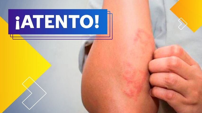 ¿Psoriasis? Te contamos sobre la enfermedad que ataca la piel 